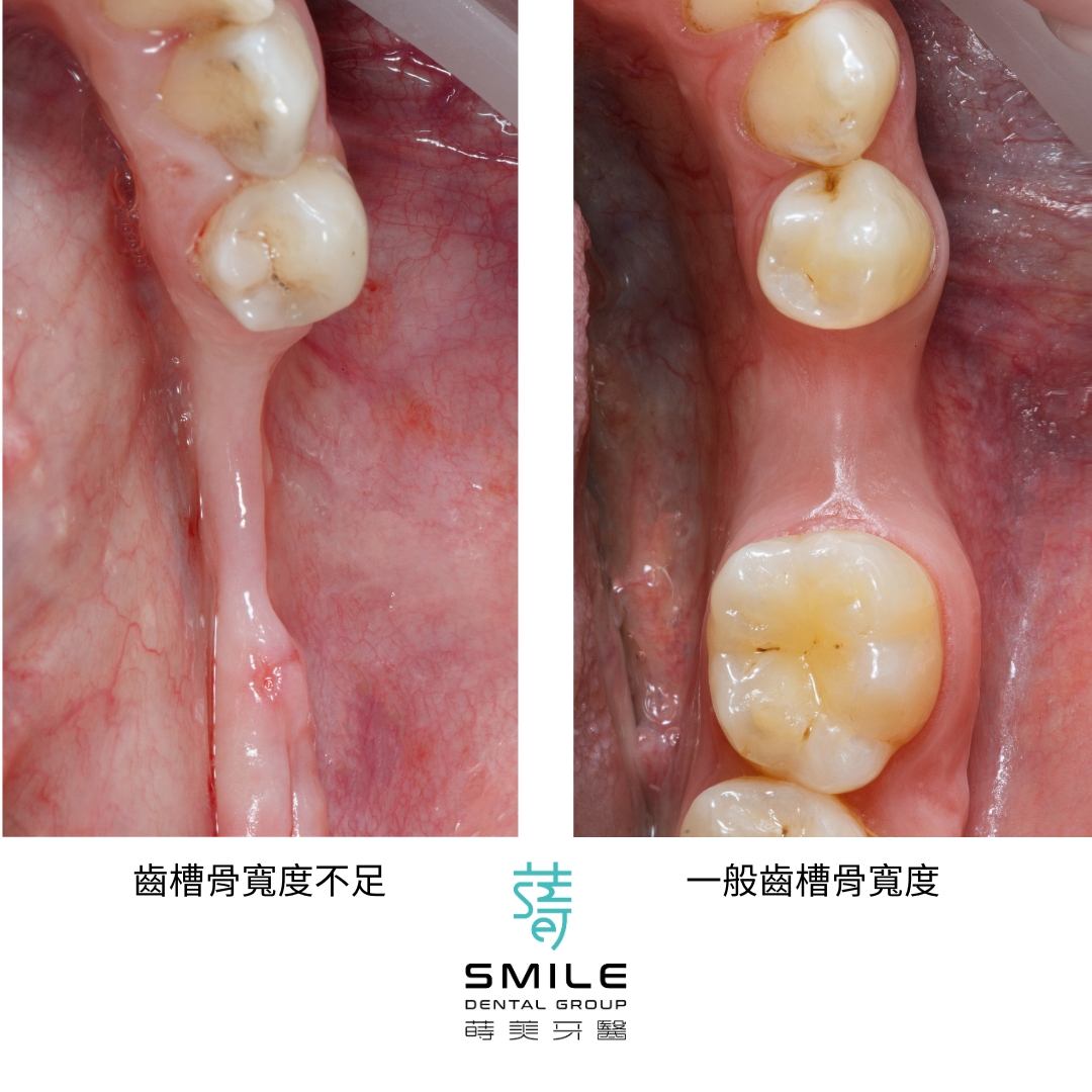 齒槽骨萎縮 補骨重建