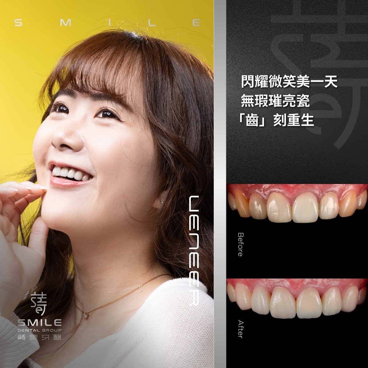全瓷貼片案例-台北陶瓷貼片推薦-蒔美牙醫-1_v2