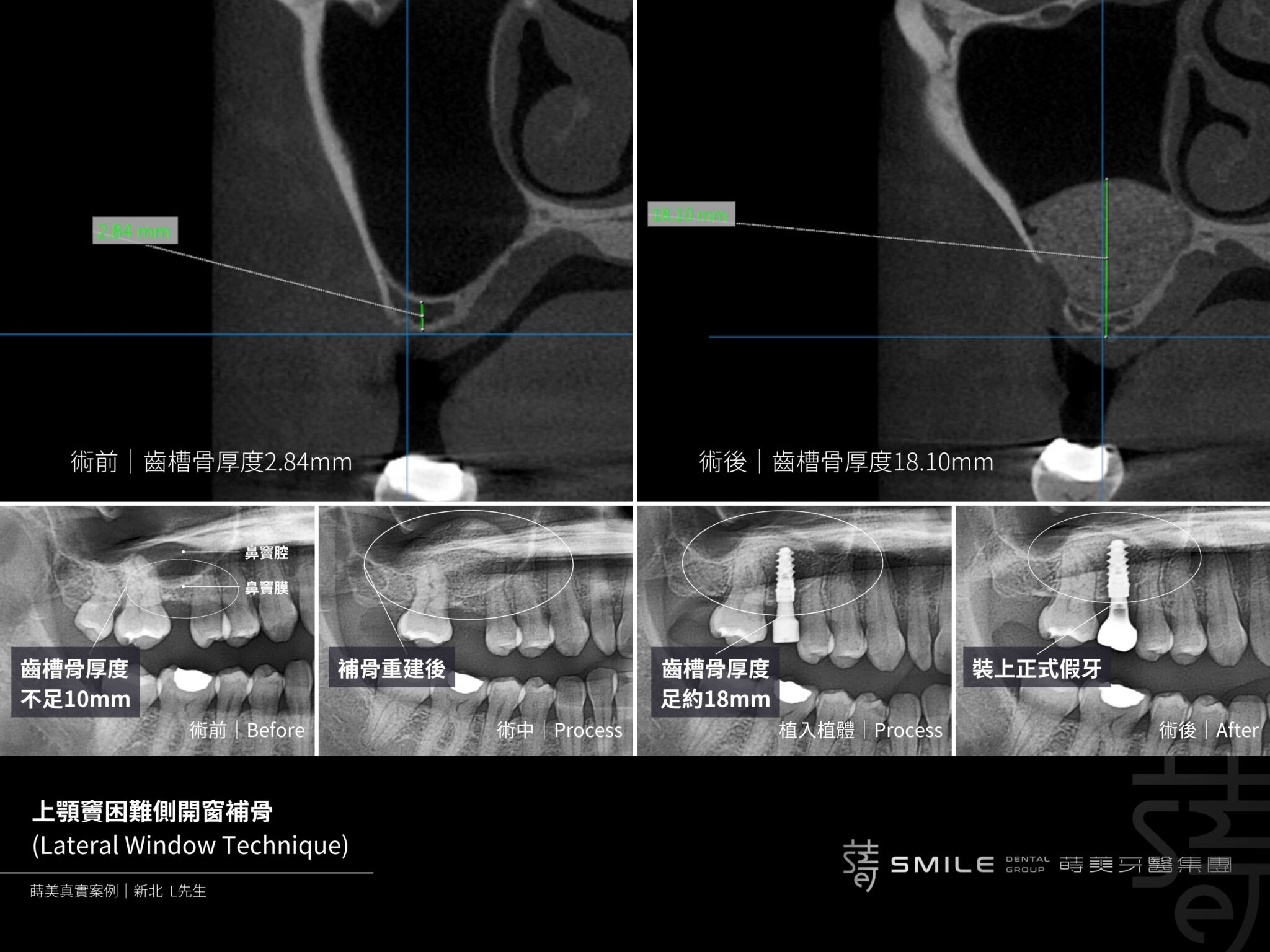 蒔美困難補骨: 補骨手術