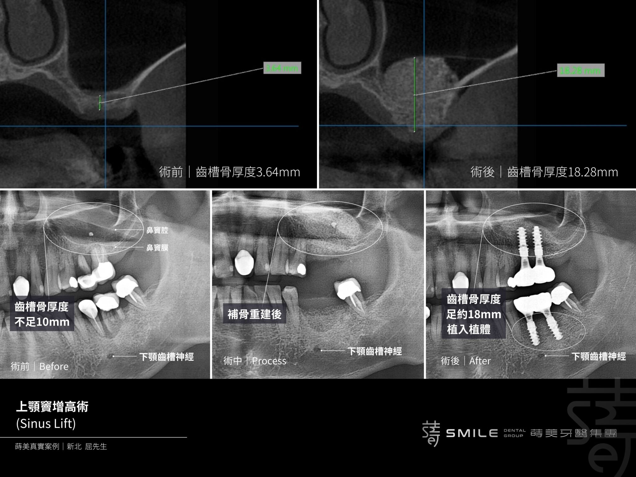 補骨流程 困難補骨 補骨手術 蒔美牙醫
