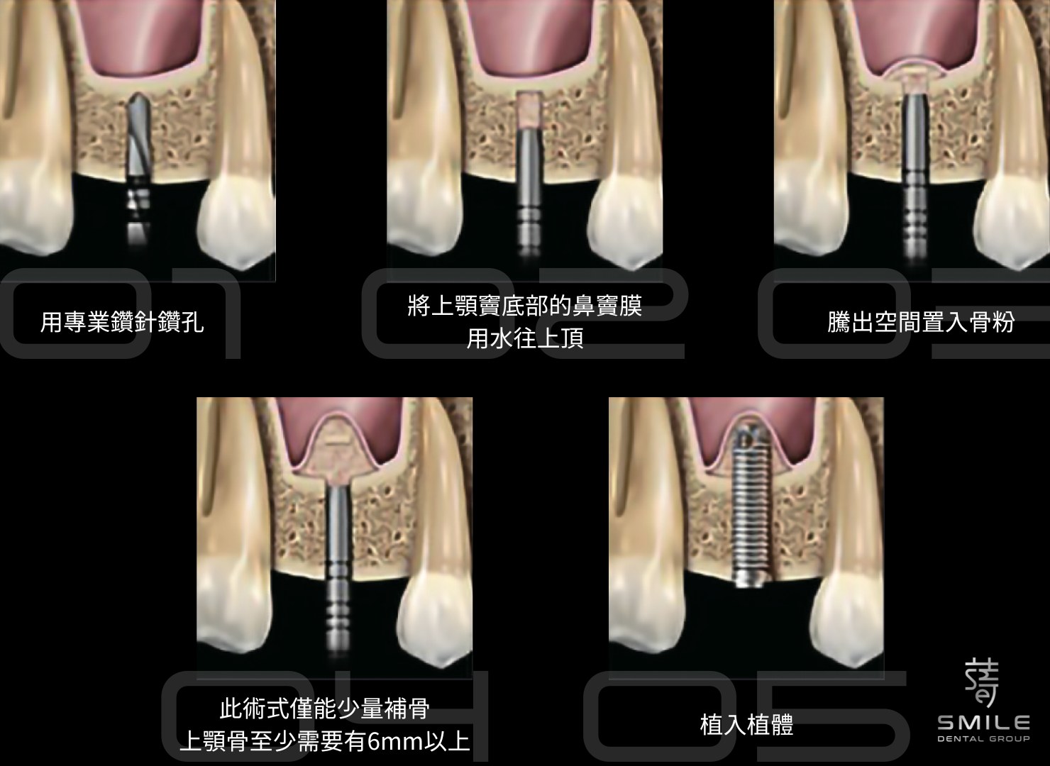鼻竇增高術