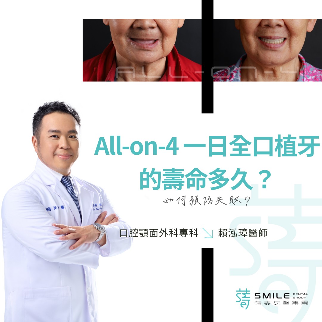 All-on-4 一日全口植牙的壽命多久？