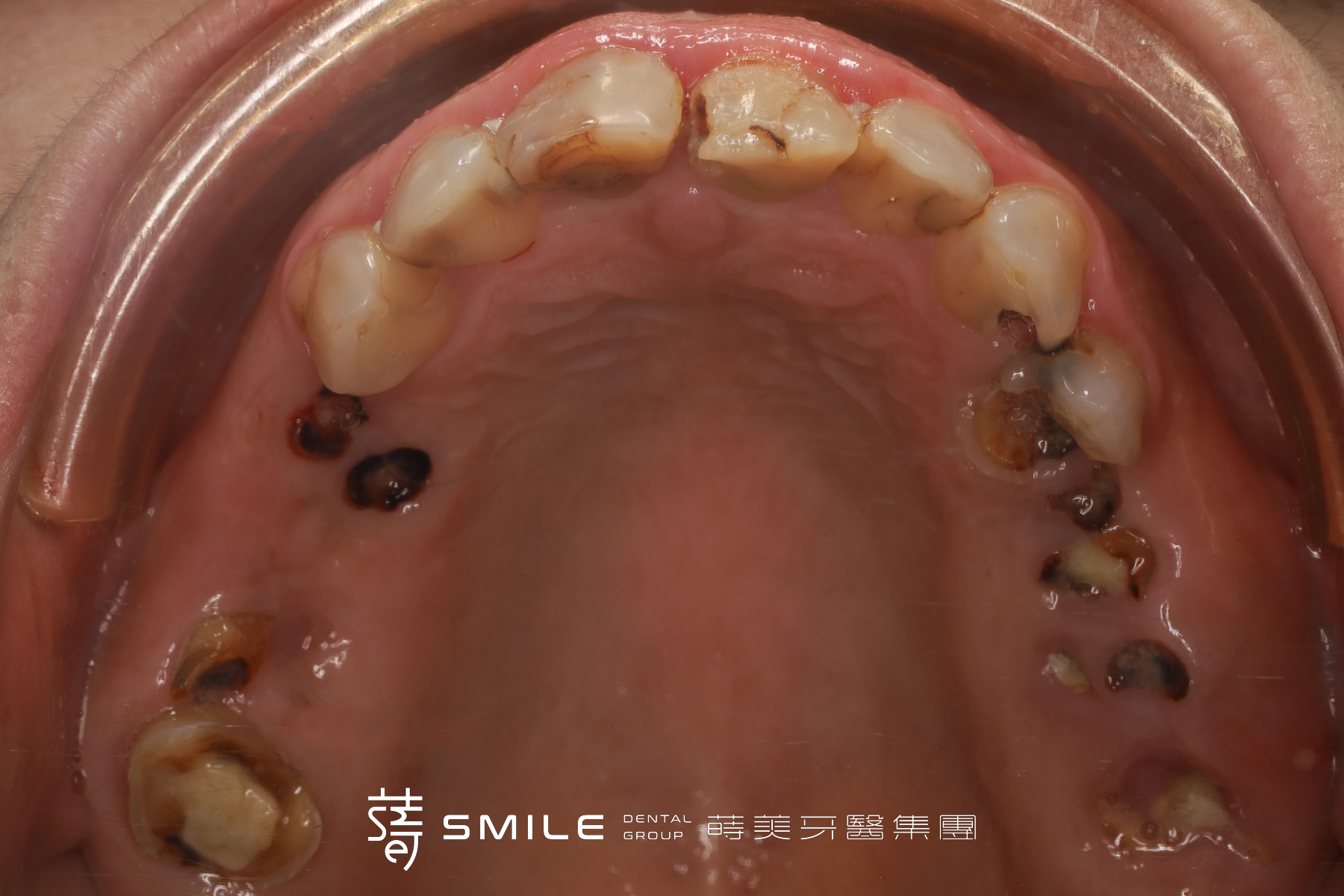 Straumann植牙案例-蒔美牙醫191-４_v2