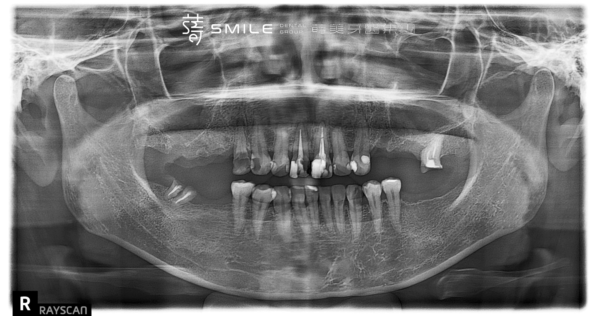 Straumann植牙案例 蒔美牙醫#191-8