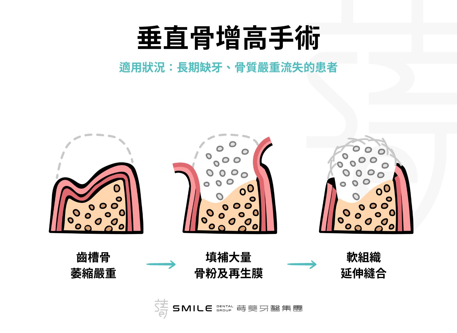 垂直骨增高手術