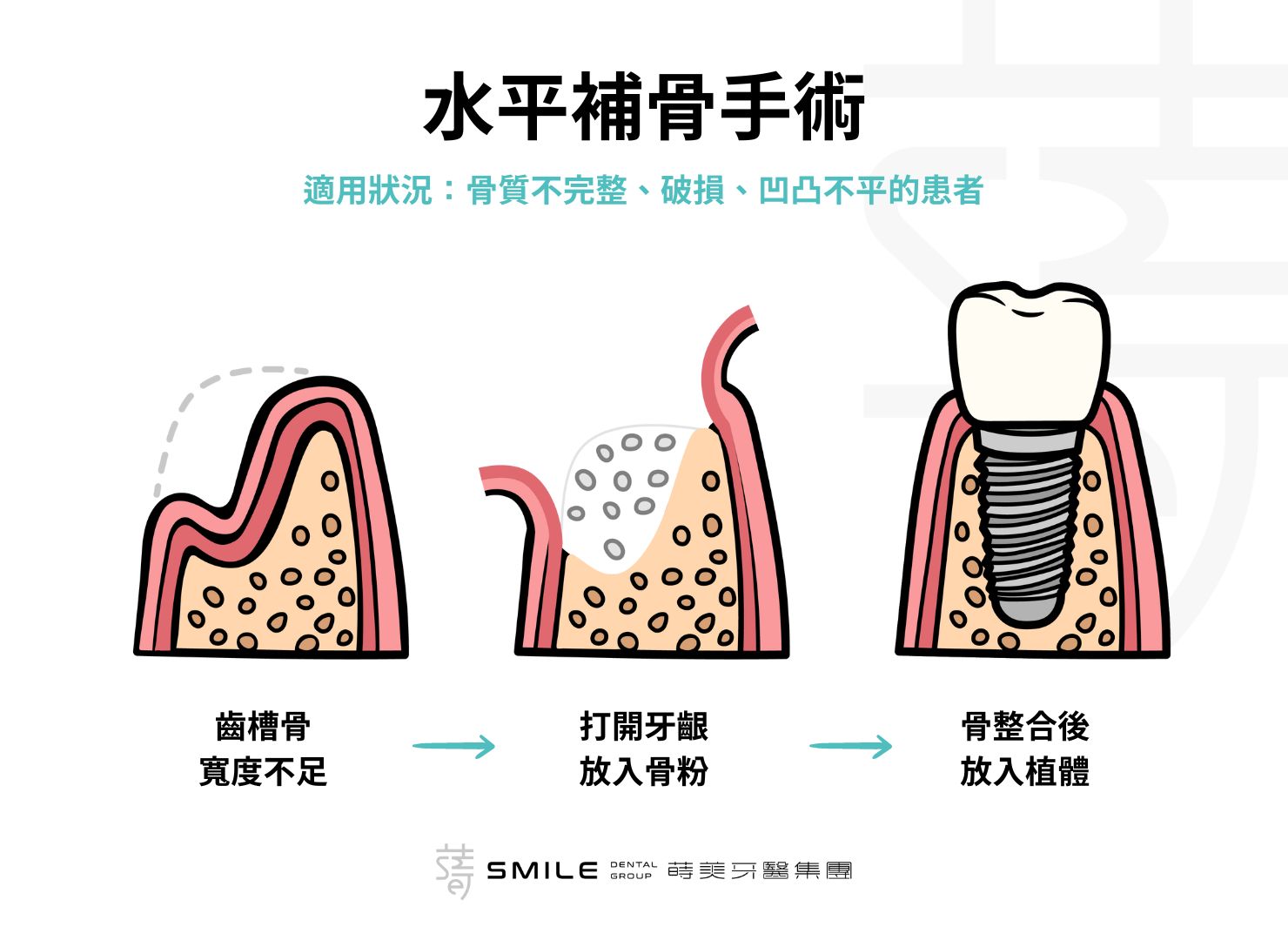 水平補骨手術