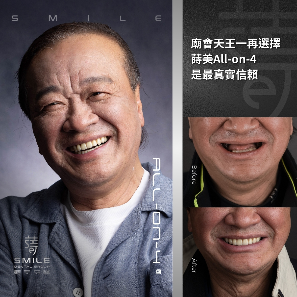 all-on-4一日全口重建案例-台北植牙推薦-蒔美牙醫-2
