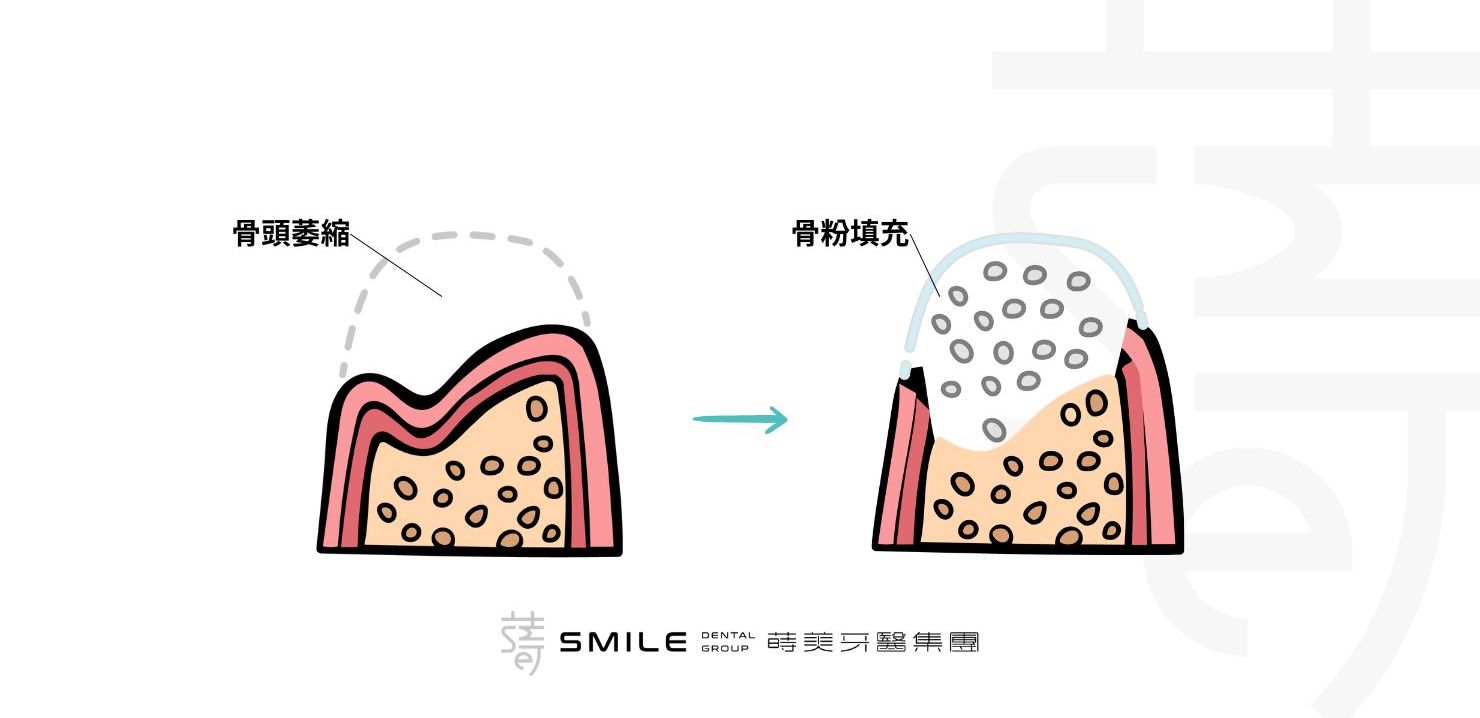 植牙補骨詳細介紹