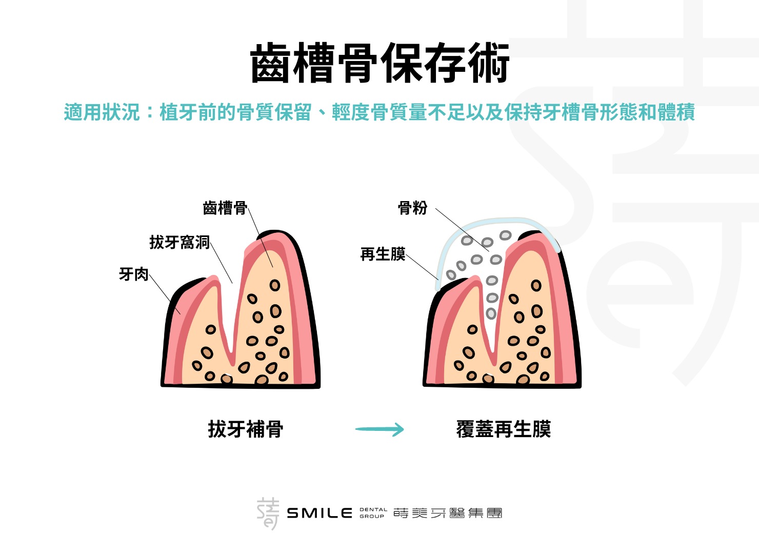 齒槽骨保存術