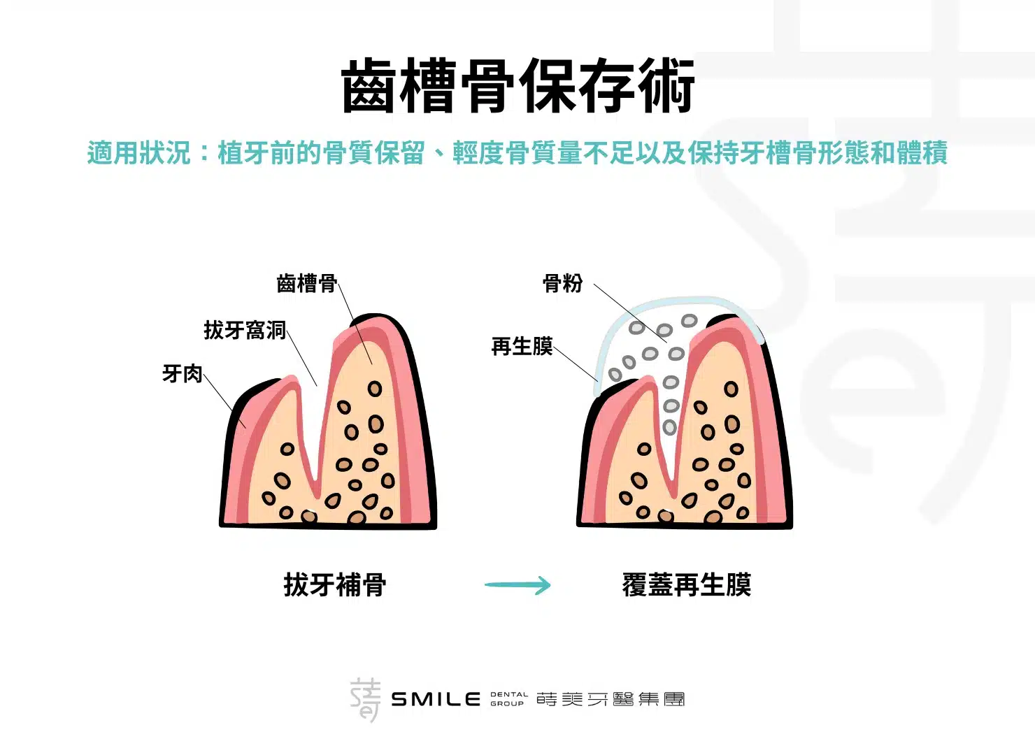 齒槽骨保存術