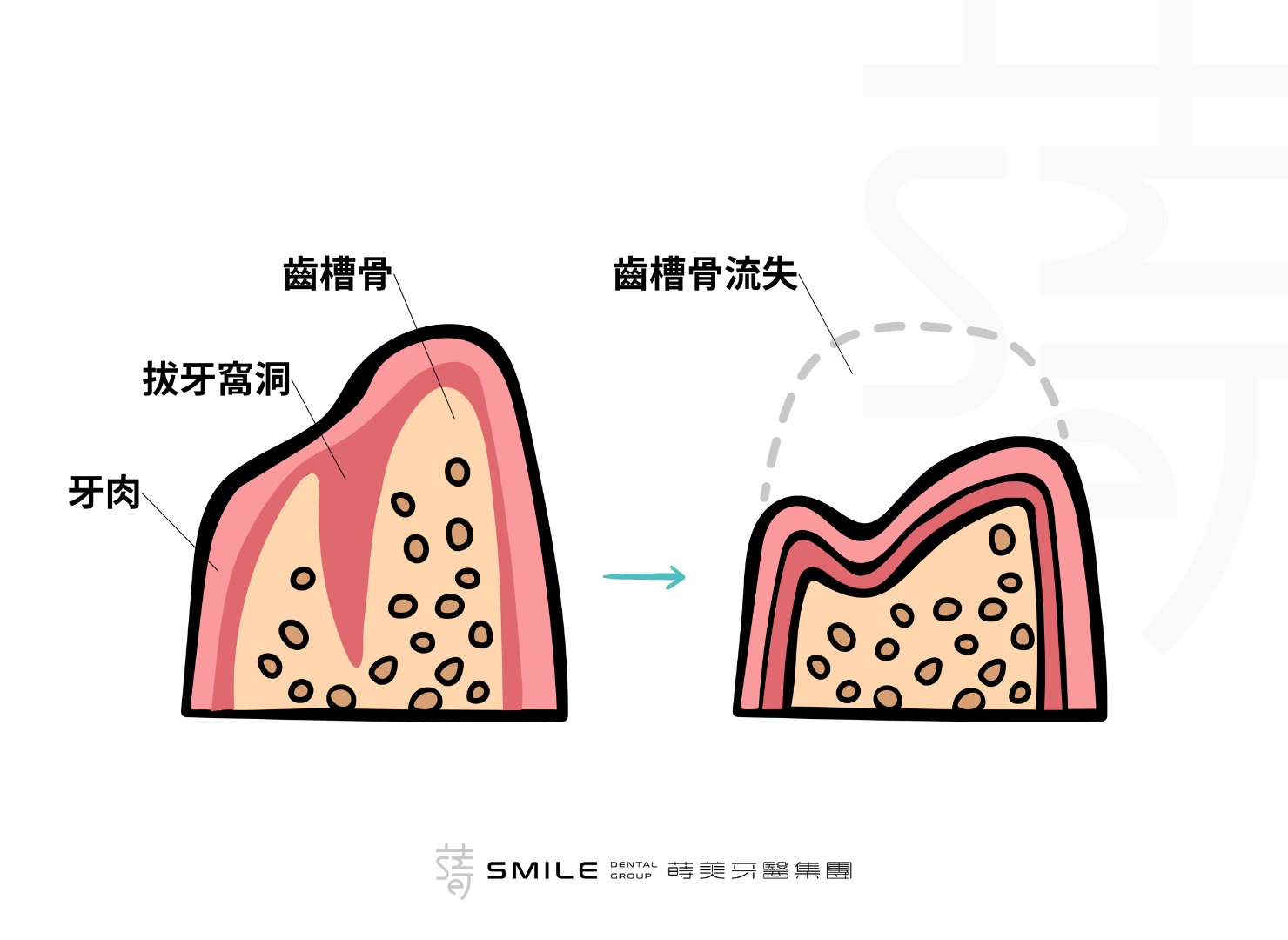 齒槽骨流失補骨手術