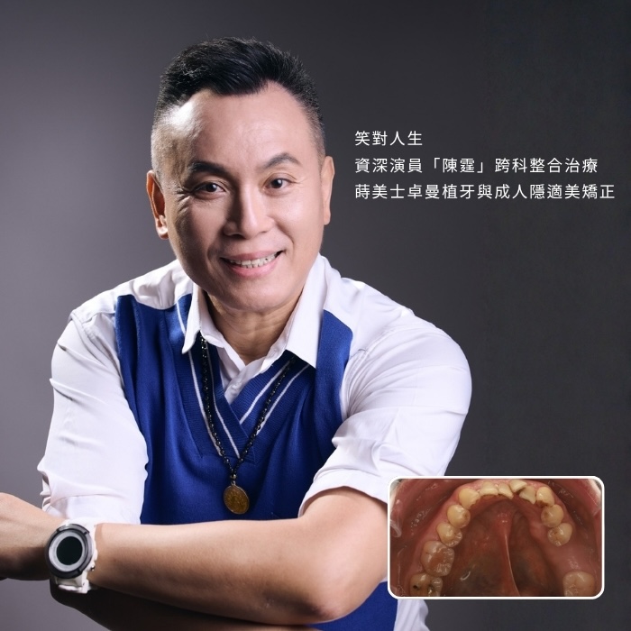 笑對人生：資深演員「陳霆」跨科整合治療，蒔美士卓曼植牙與成人隱適美矯正