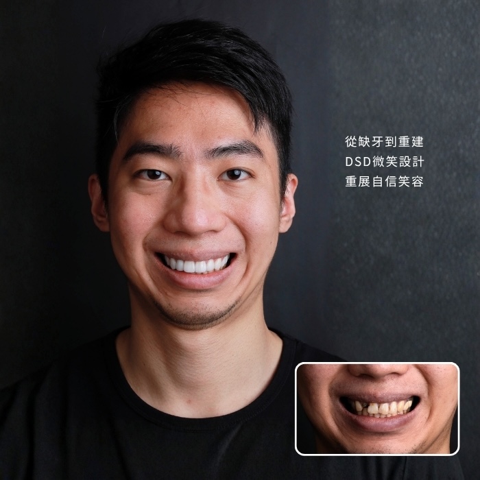 從缺牙到重建，DSD微笑設計重展自信笑容