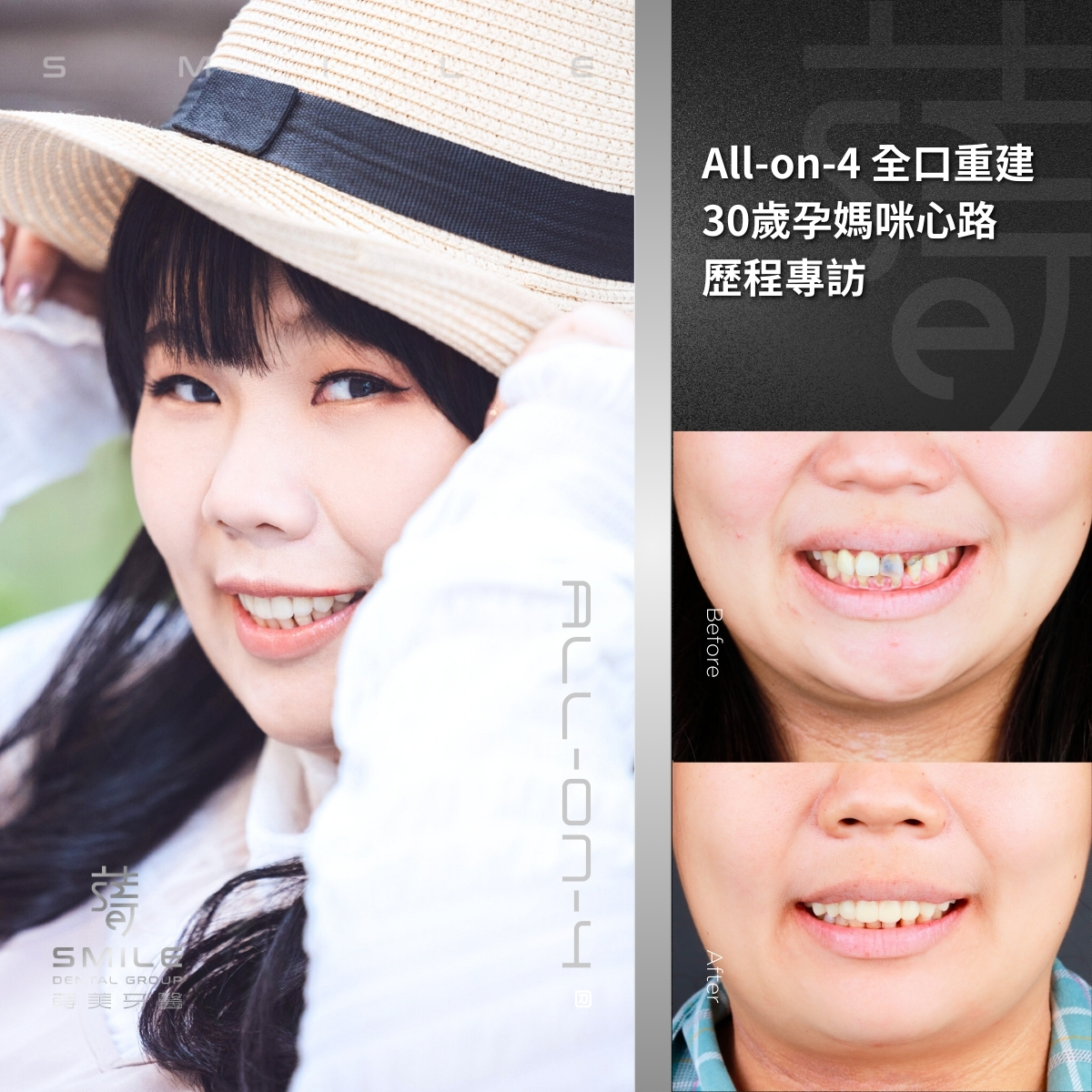 all-on-4一日全口重建案例-台北植牙推薦-蒔美牙醫-2