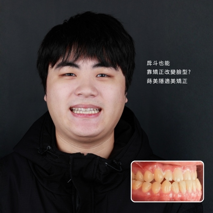 戽斗也能靠矯正改變臉型_ 蒔美隱適美矯正