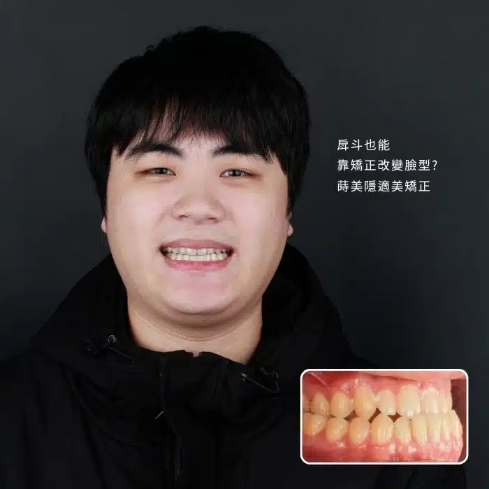 戽斗也能靠矯正改變臉型_ 蒔美隱適美矯正