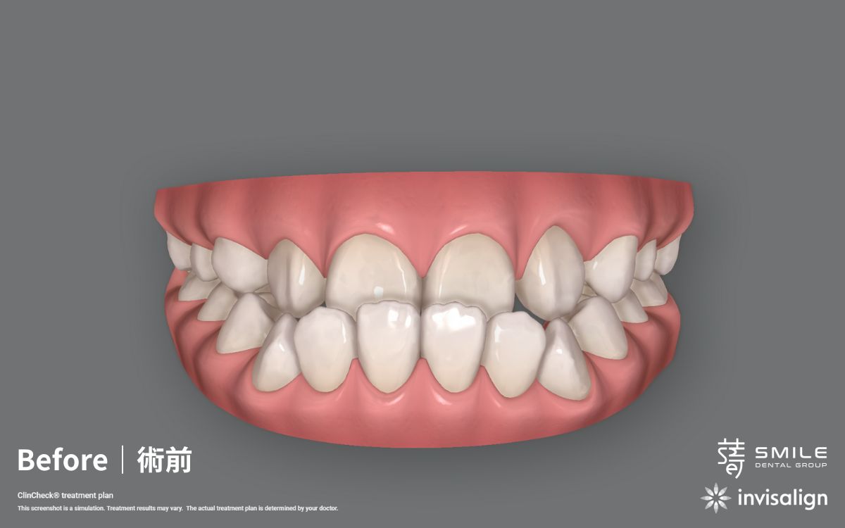 案例52154/Before_兒童_戽斗_生長空間不足_拔_Dr柯_兒童隱適美矯正_孩子自信微笑_改善戽斗與咬合 (4)