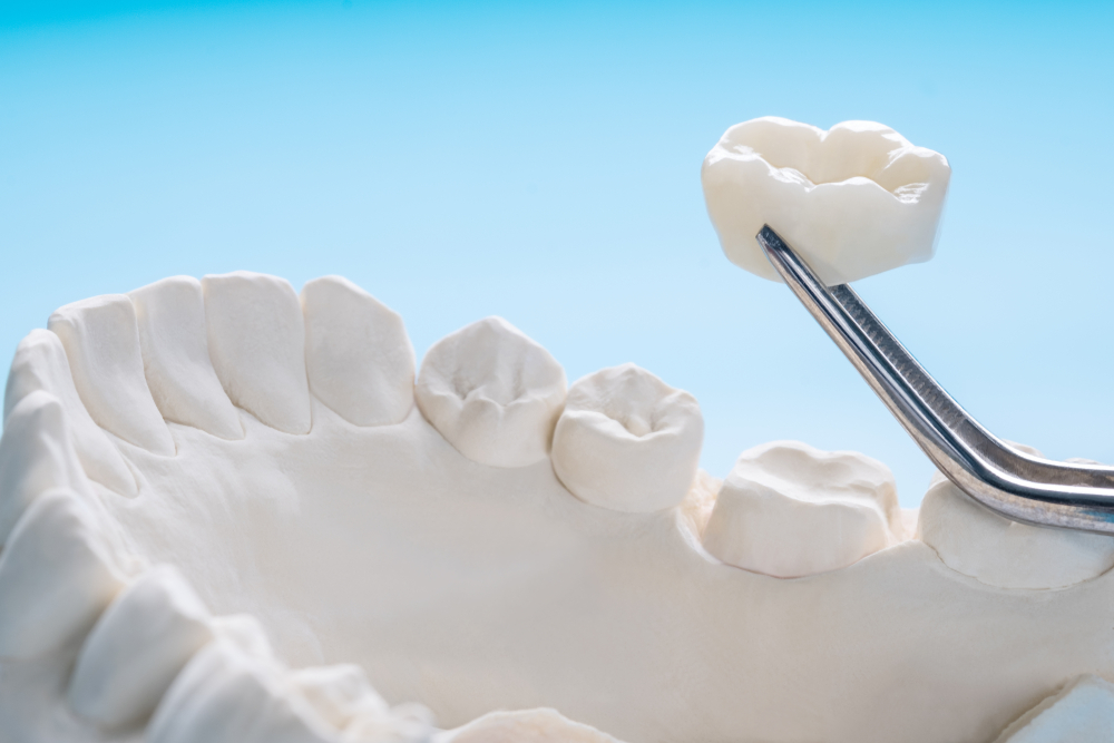 Closeup,/,Prosthodontics,Or,Prosthetic,/,Single,Teeth,Crown,And