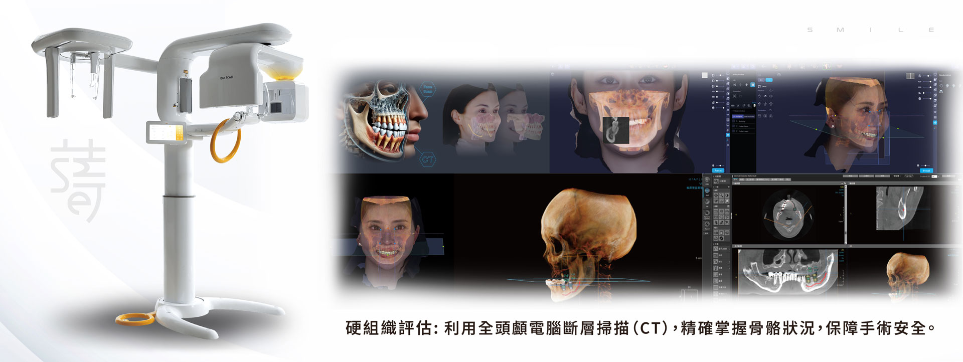 謝小姐一場意外改變了她的笑容植牙讓自信回來蒔美-CT