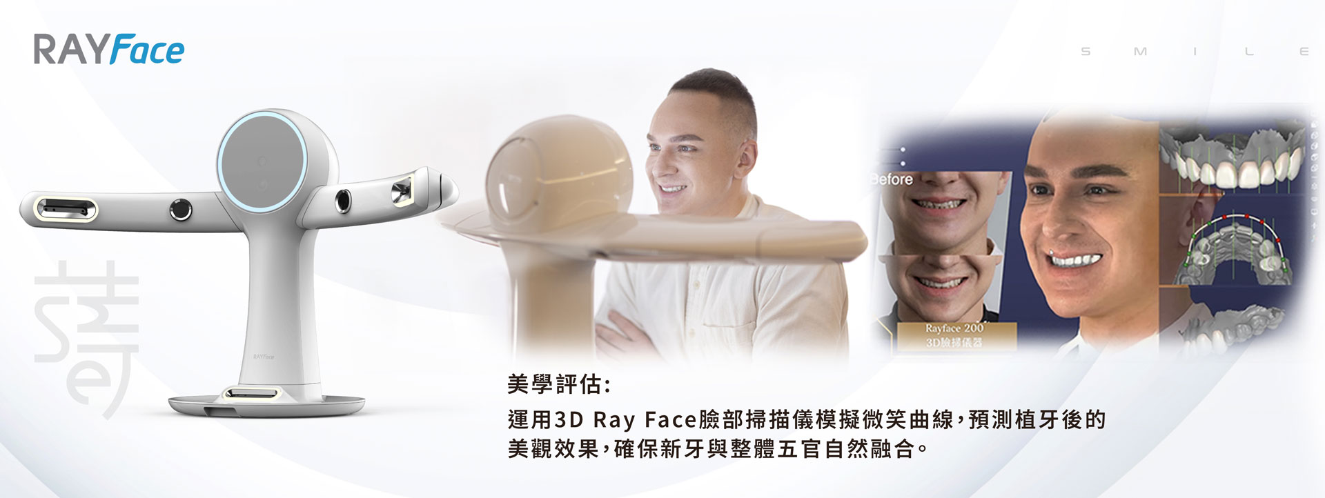 謝小姐一場意外改變了她的笑容植牙讓自信回來蒔美-Ray-face-拷貝