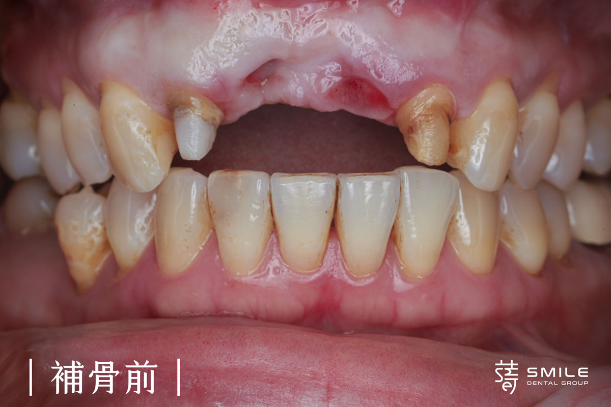 謝小姐一場意外改變了她的笑容植牙讓自信回來1