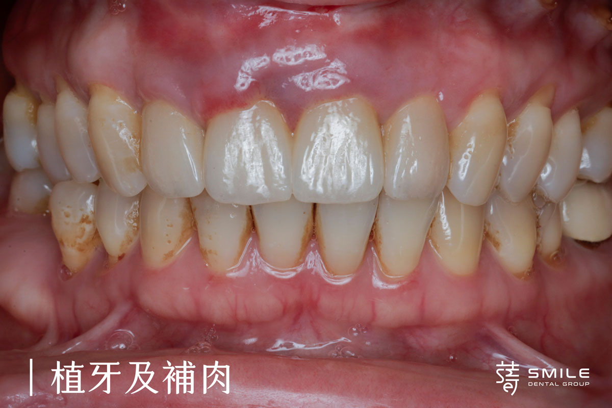 謝小姐一場意外改變了她的笑容植牙讓自信回來3