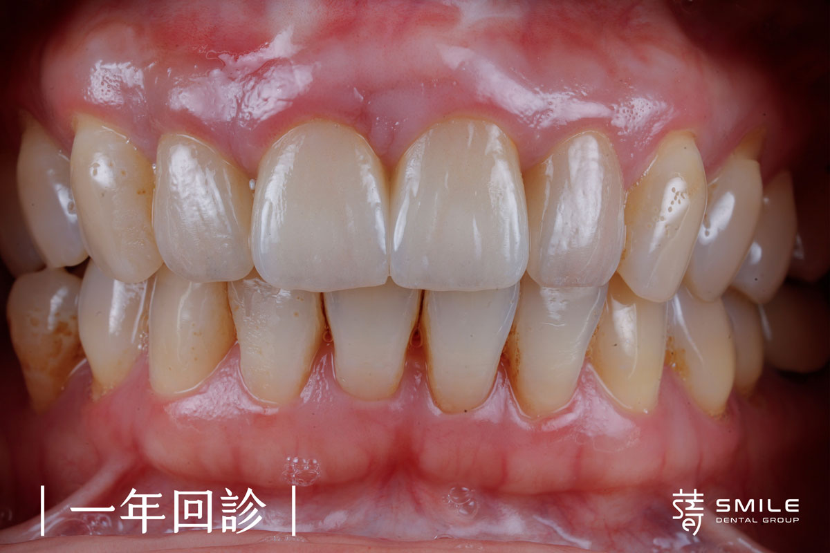 謝小姐一場意外改變了她的笑容植牙讓自信回來5