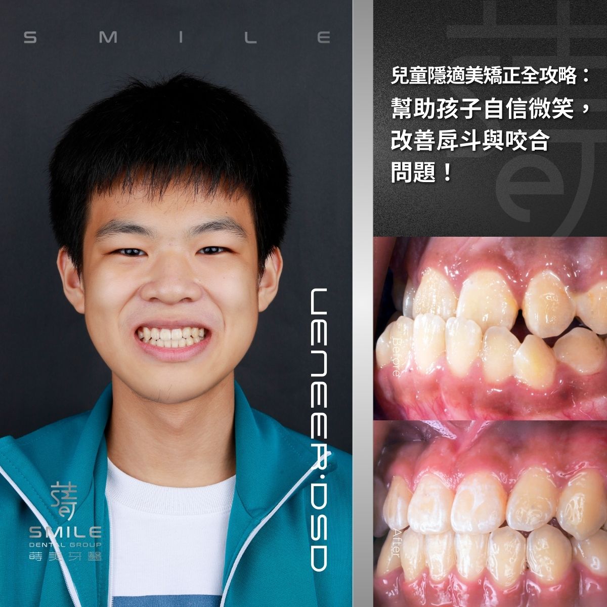 案例52154/Dr柯_980227洪翊華_11歲_戽斗_生長空間不足_拔14243444
