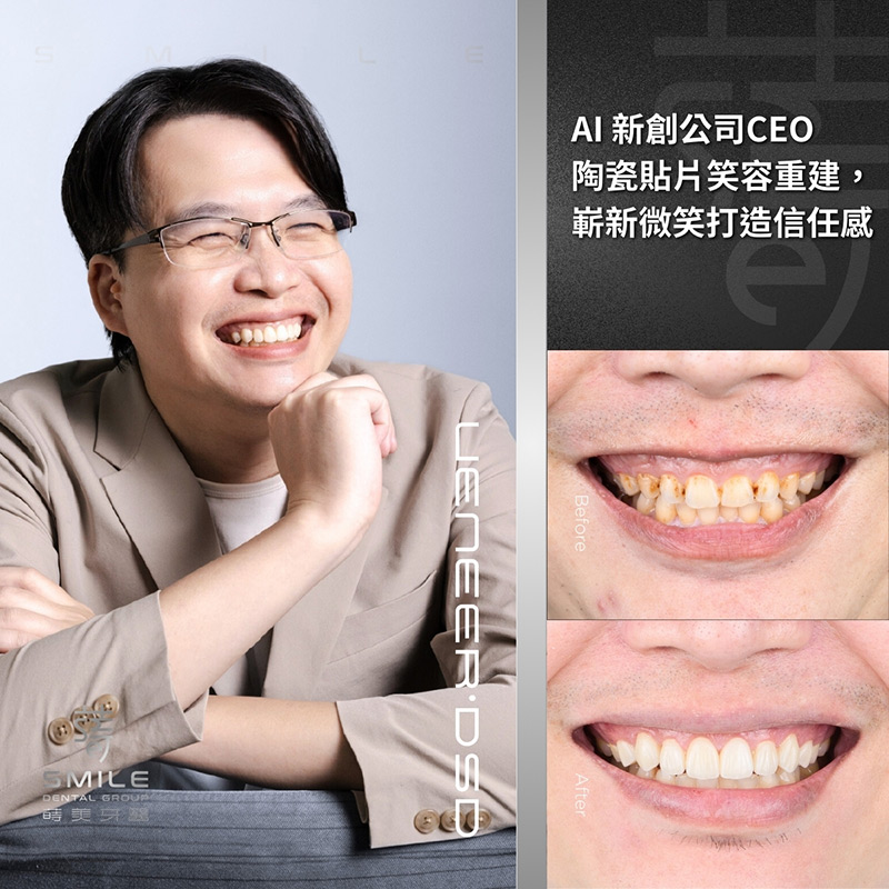 all-on-4一日全口重建案例-台北植牙推薦-蒔美牙醫-2-2