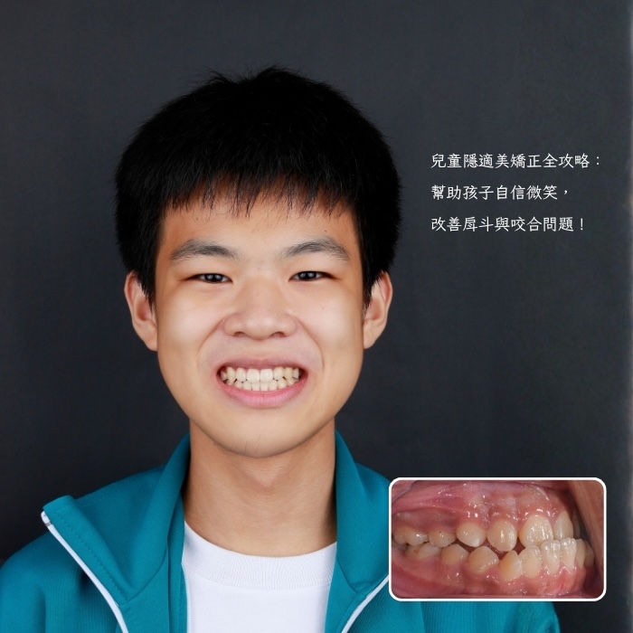 兒童隱適美矯正全攻略：幫助孩子自信微笑，改善戽斗與咬合問題！