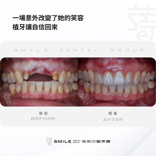 植牙案例封面-一場意外改變了她的笑容，植牙讓自信回來600 x 600