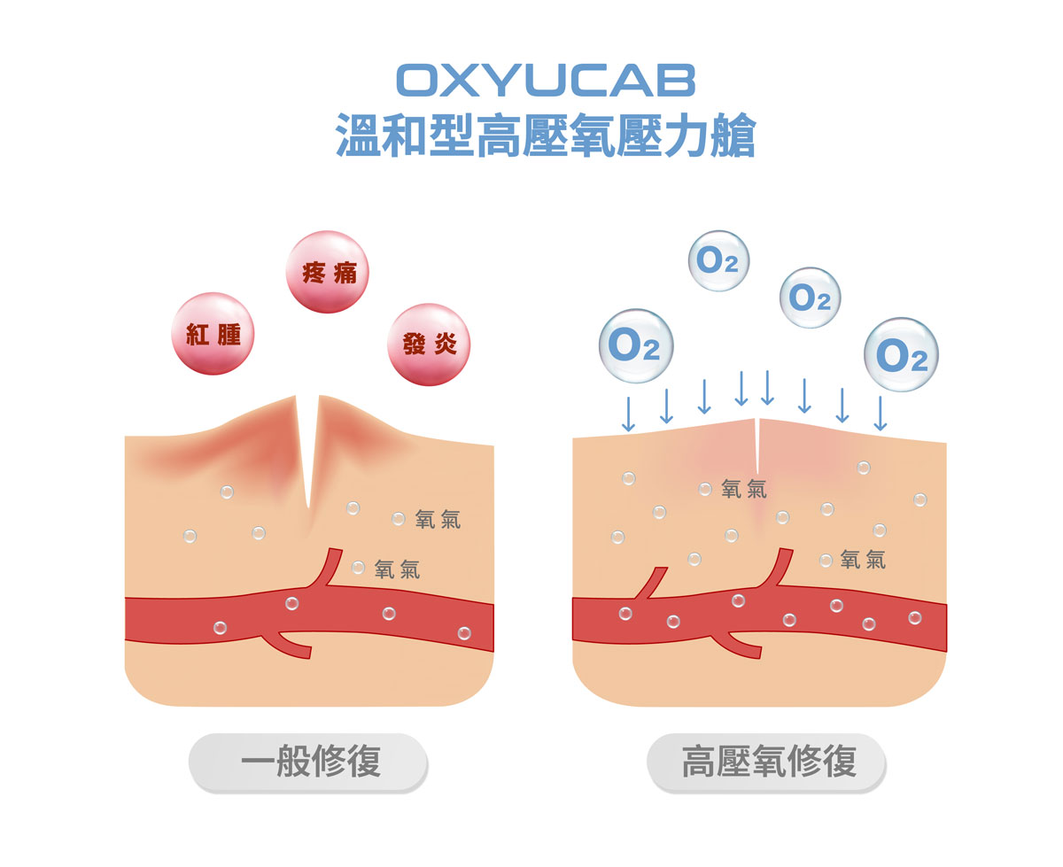 高壓氧插圖-