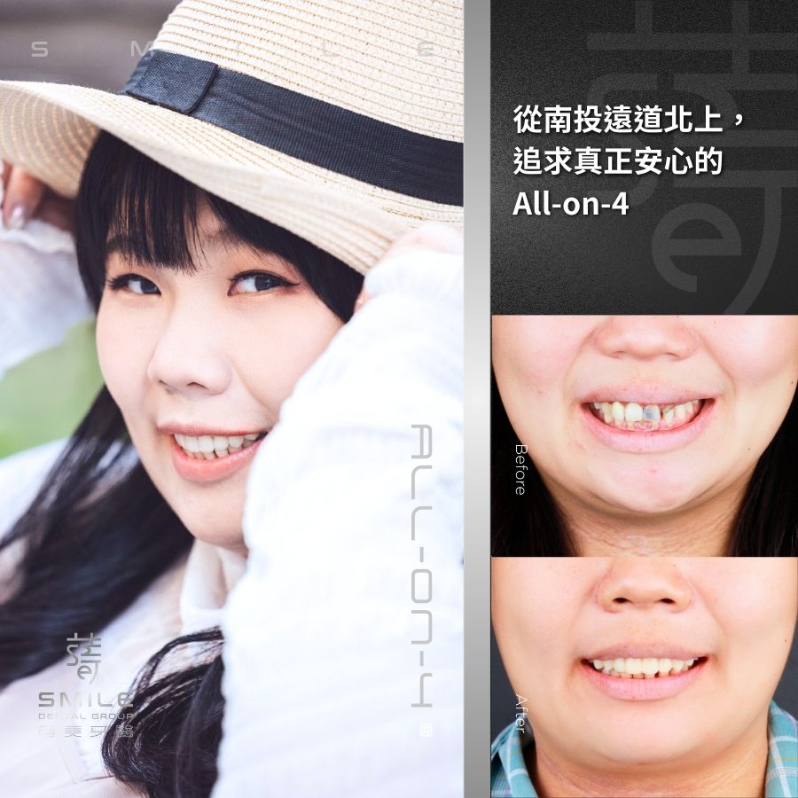 all-on-4一日全口重建案例-台北植牙推薦-蒔美牙醫-3