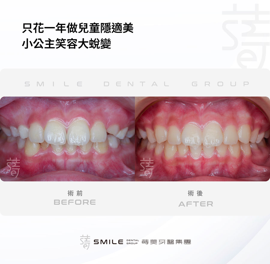 廖-只花一年-小公主隱適美笑容大變身