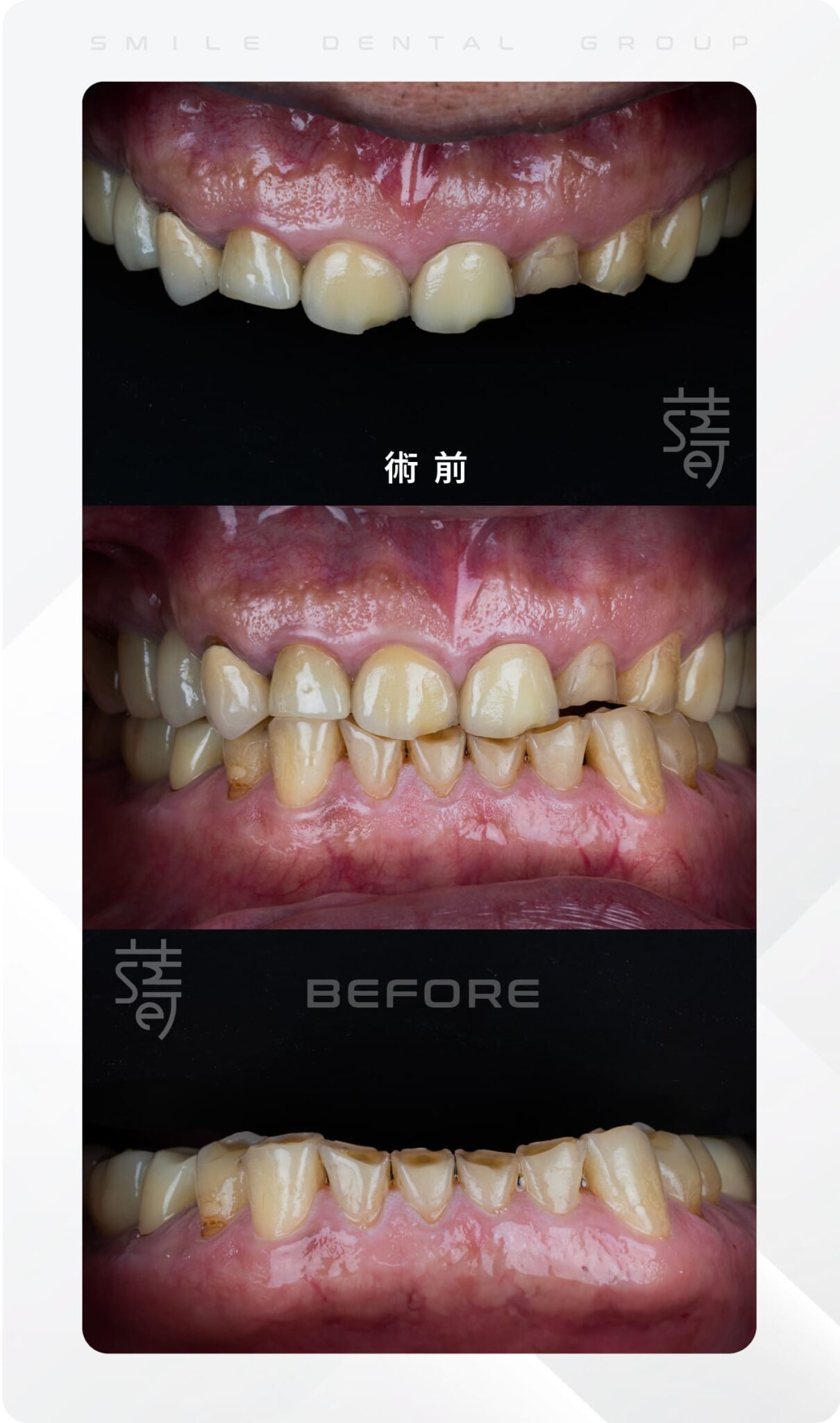 林世達 全口咬合重建-04
