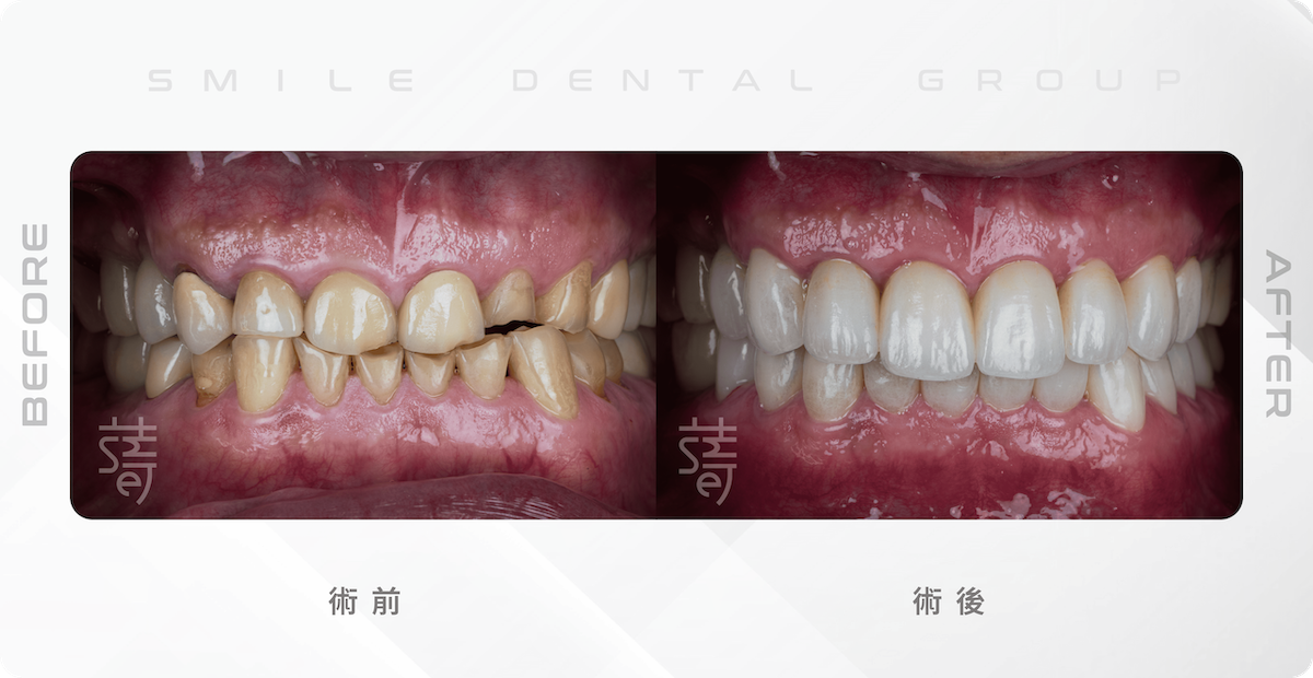 林-全口咬合重建-01