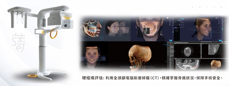 謝小姐一場意外改變了她的笑容植牙讓自信回來蒔美-CT