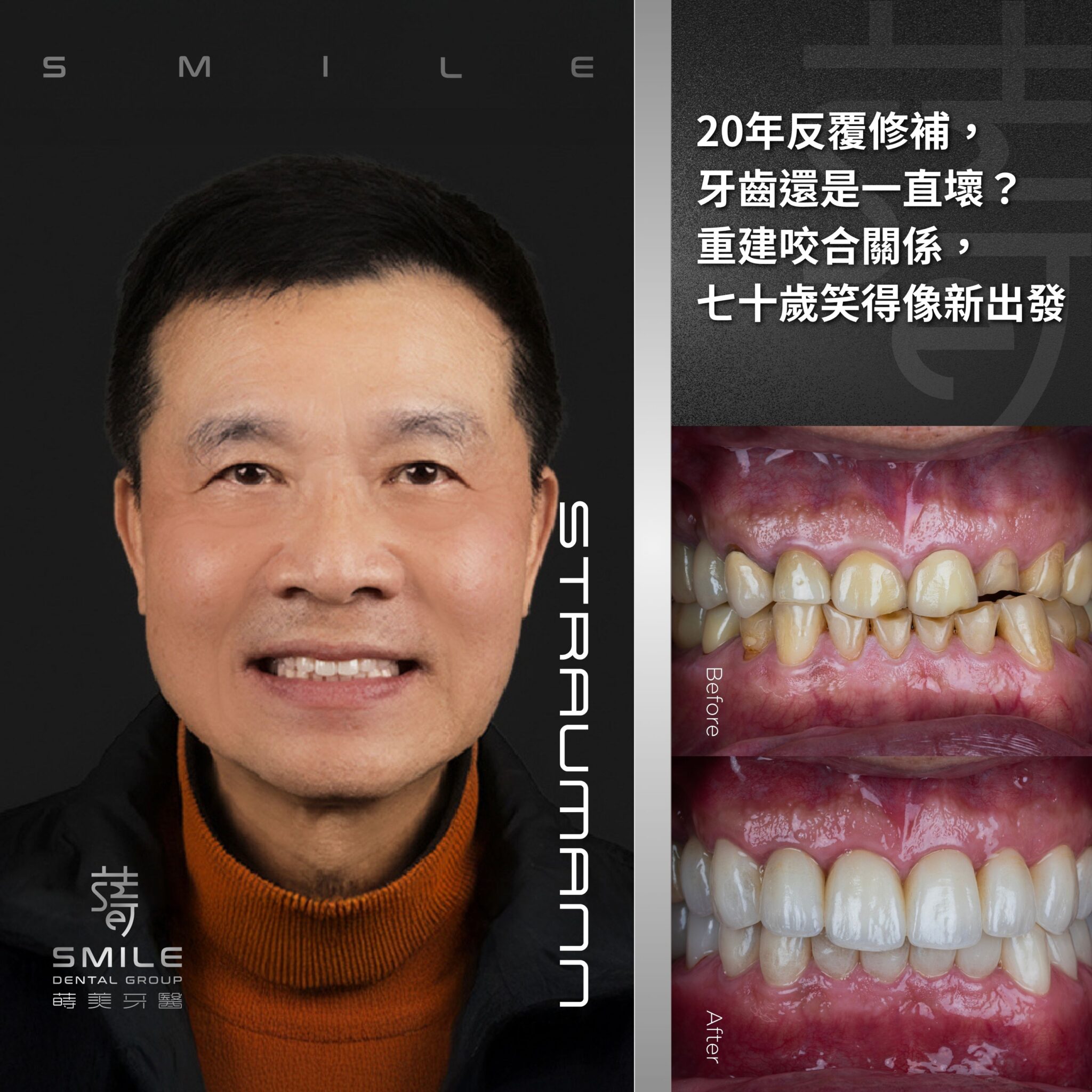 20年反覆修補， 牙齒還是一直壞？ 重建咬合關係讓七十歲也能笑得像新出發