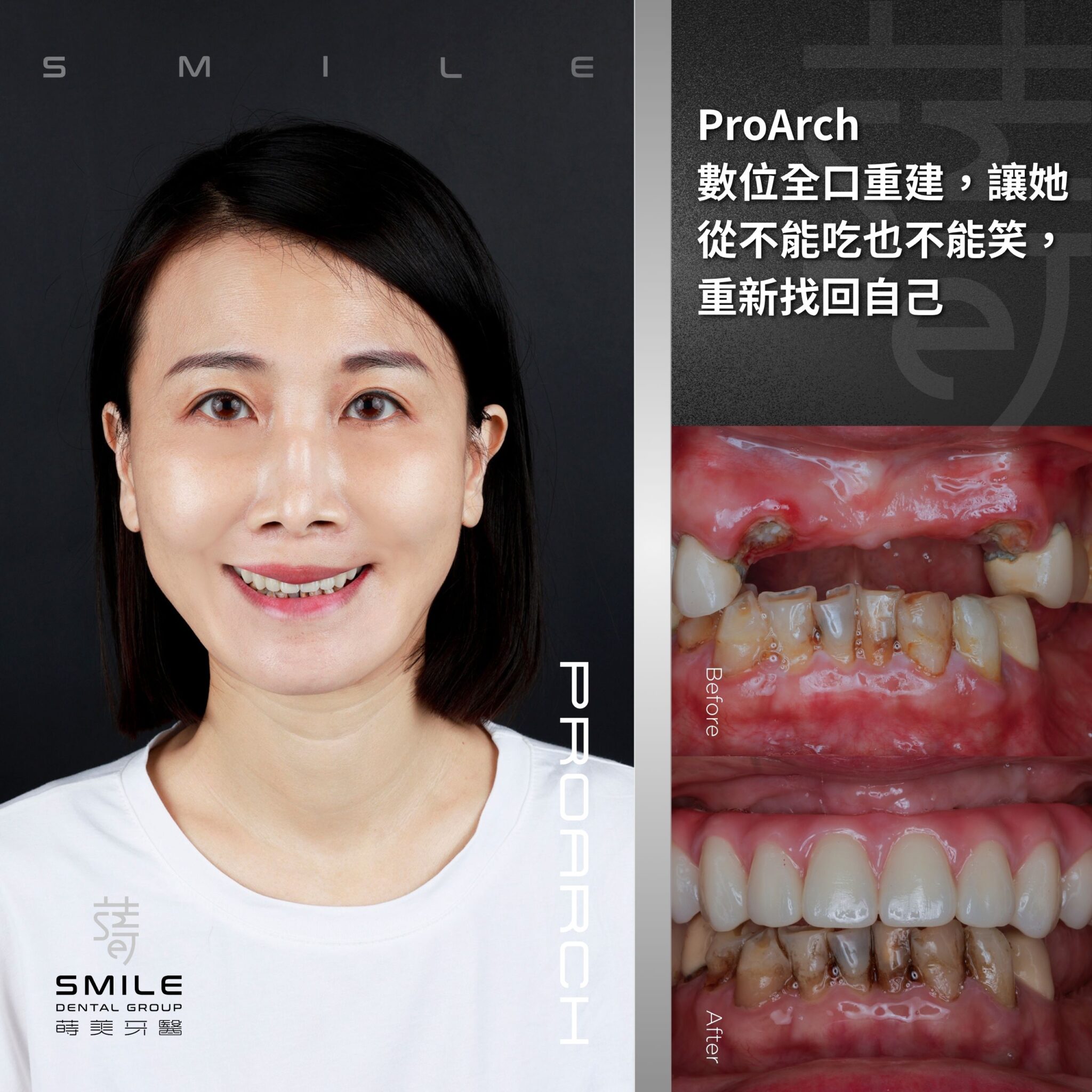 ProArch 數位全 口重建，讓她從不能吃也不能笑，重新找回自己拷貝