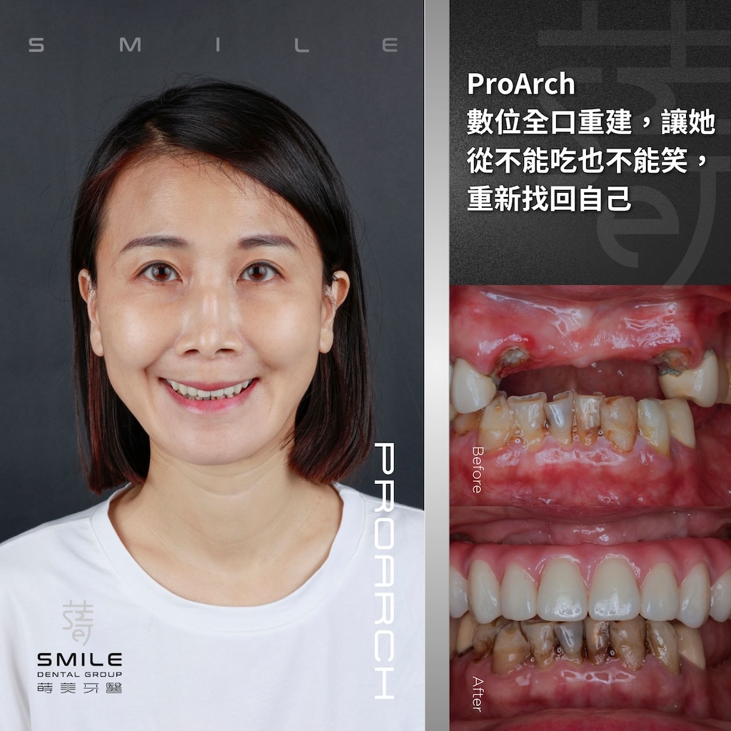 官網案例封面 - ProArch 數位全 口重建，讓她從不能吃也不能笑，重新找回自己