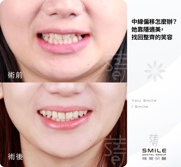 中線偏移怎麼辦-她靠隱適美,找回整齊的笑容