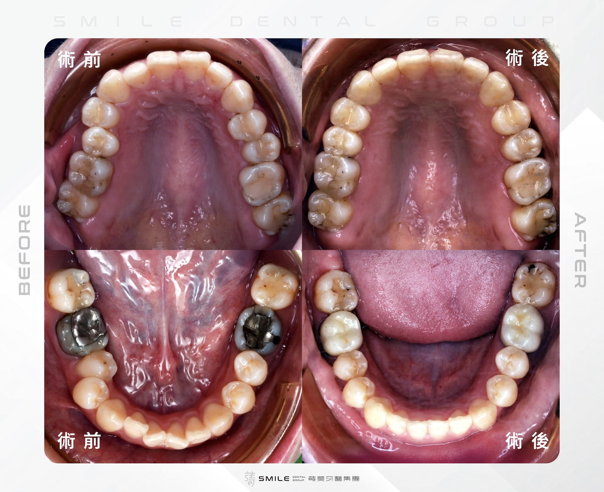 patient's before and after invisalign