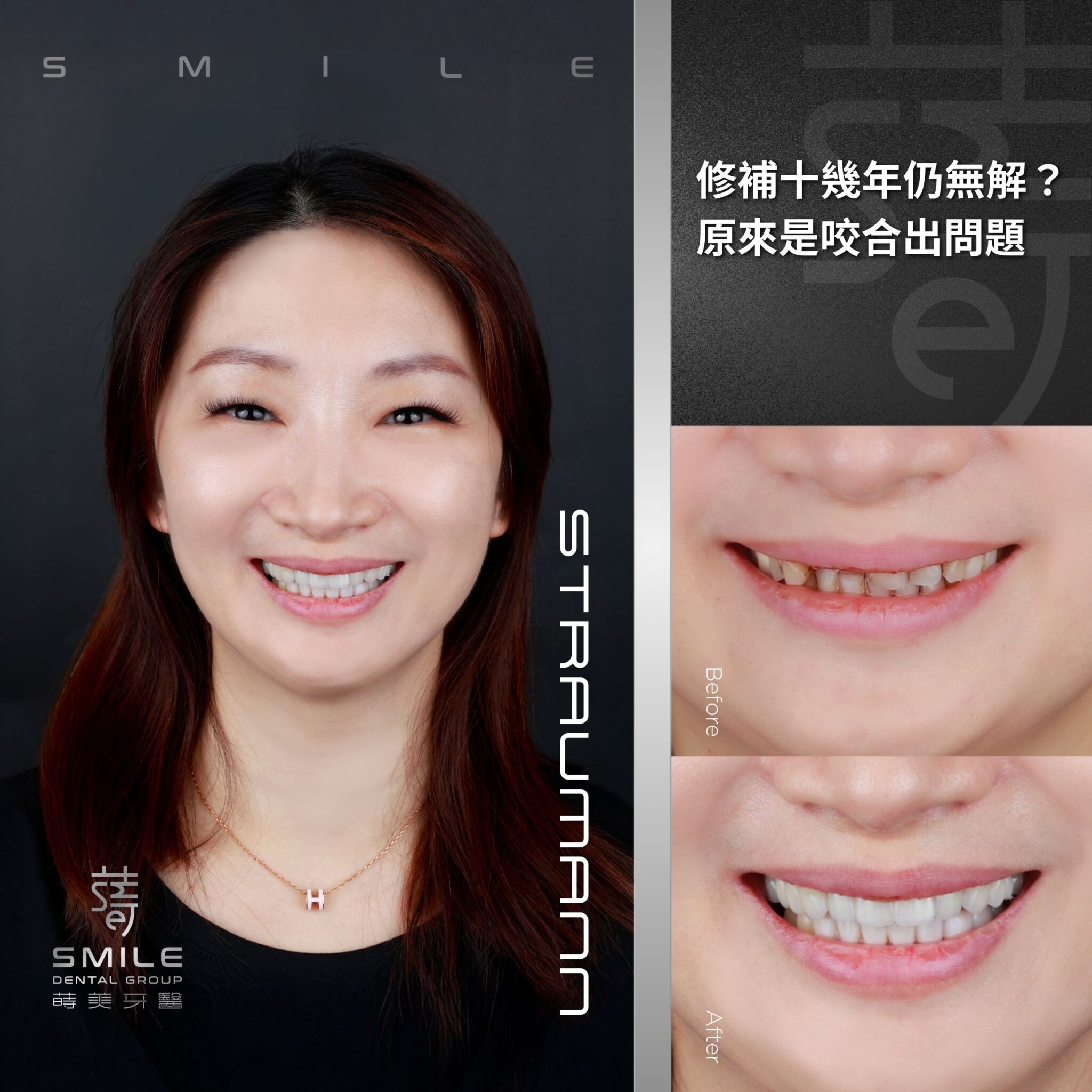 官網案例封面 - 美麗不分階段， 全瓷貼片讓你 談笑風生不費力