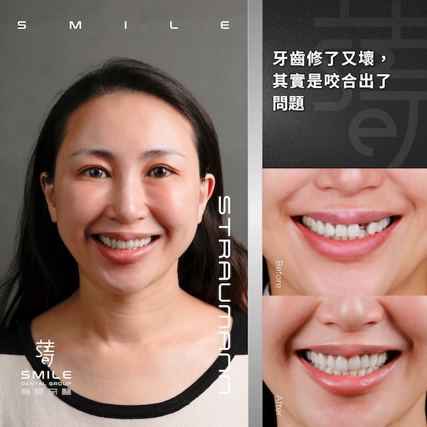 官網案例封面 - 牙齒修了又壞，其實是咬合出了問題