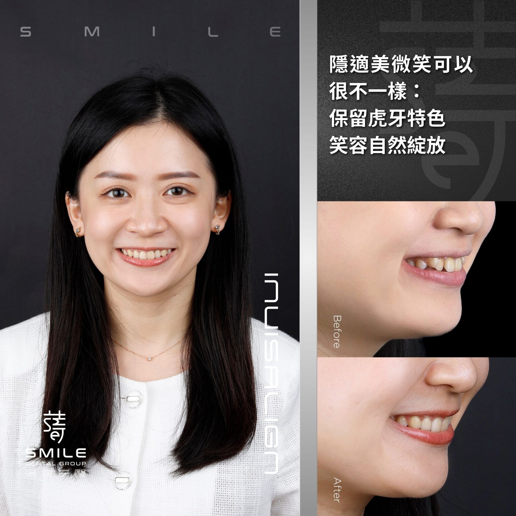 隱適美微笑可以很不一樣：保留虎牙特色，笑容自然綻放 (1)