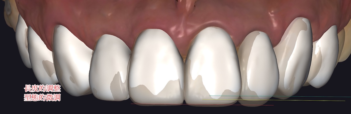 楊 上顎切端改變
