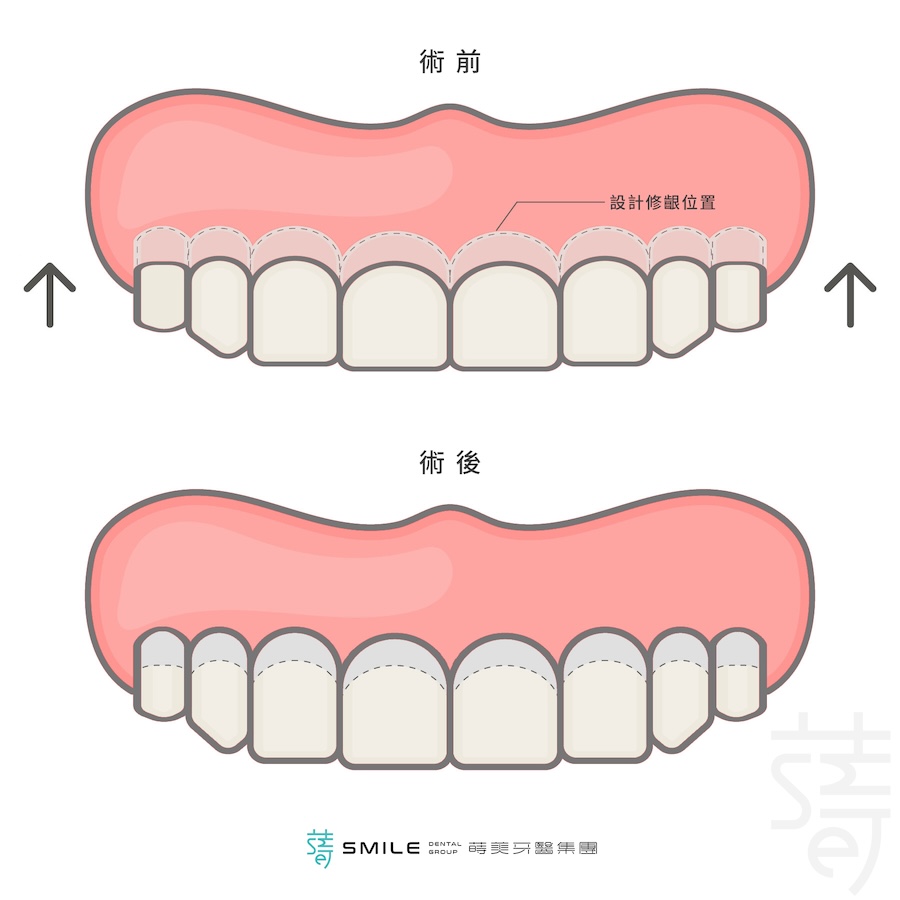 牙冠 增長術修牙齦圖
