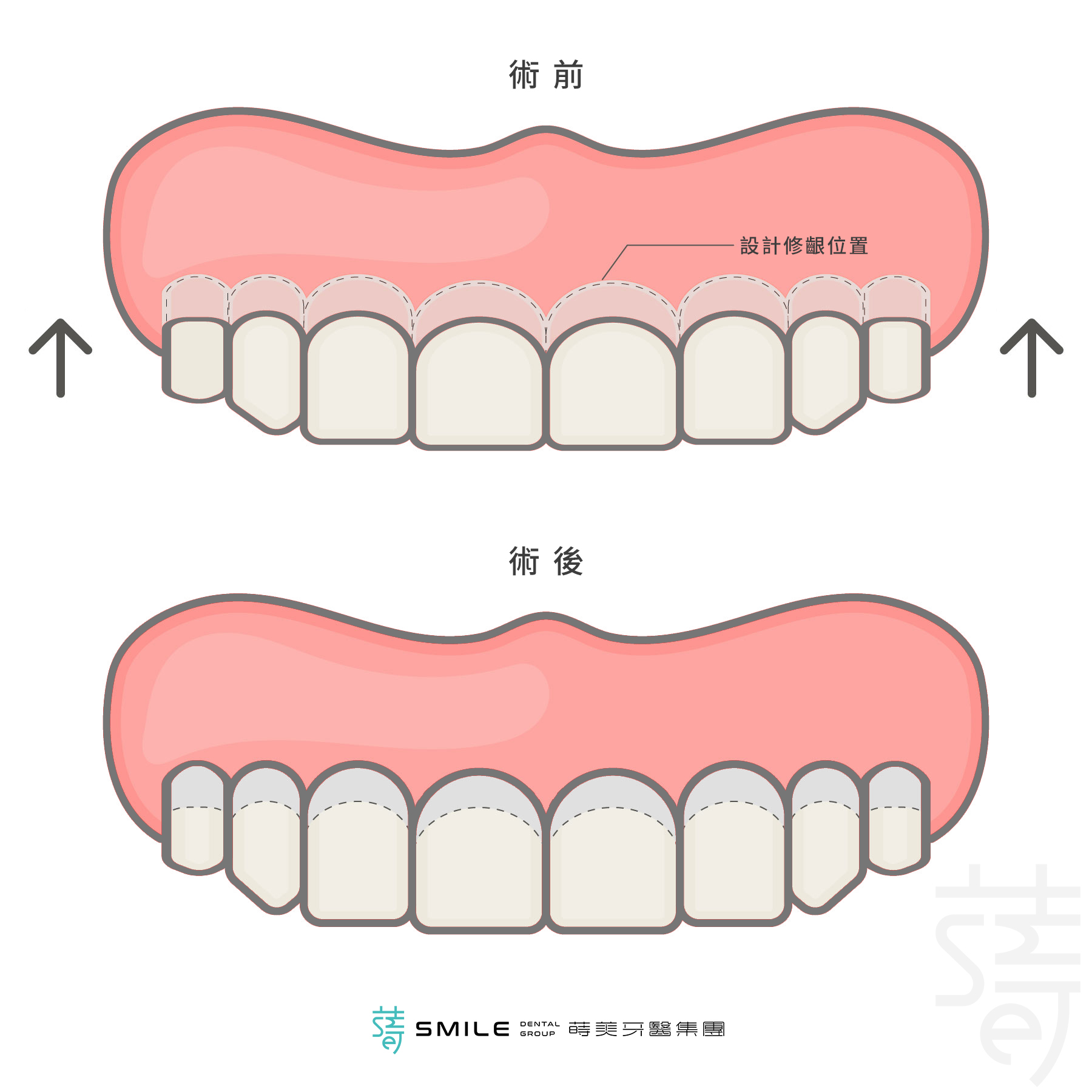 牙冠 增長術修牙齦圖