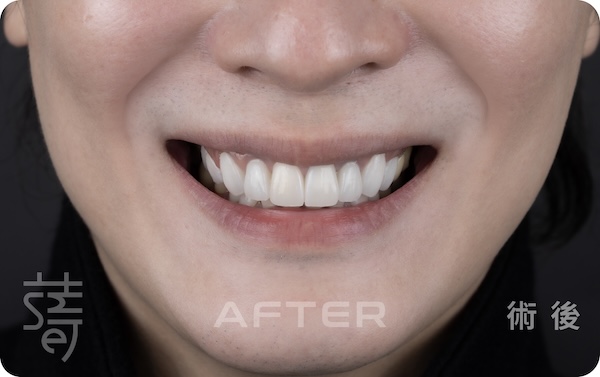 2全口咬合重建-04