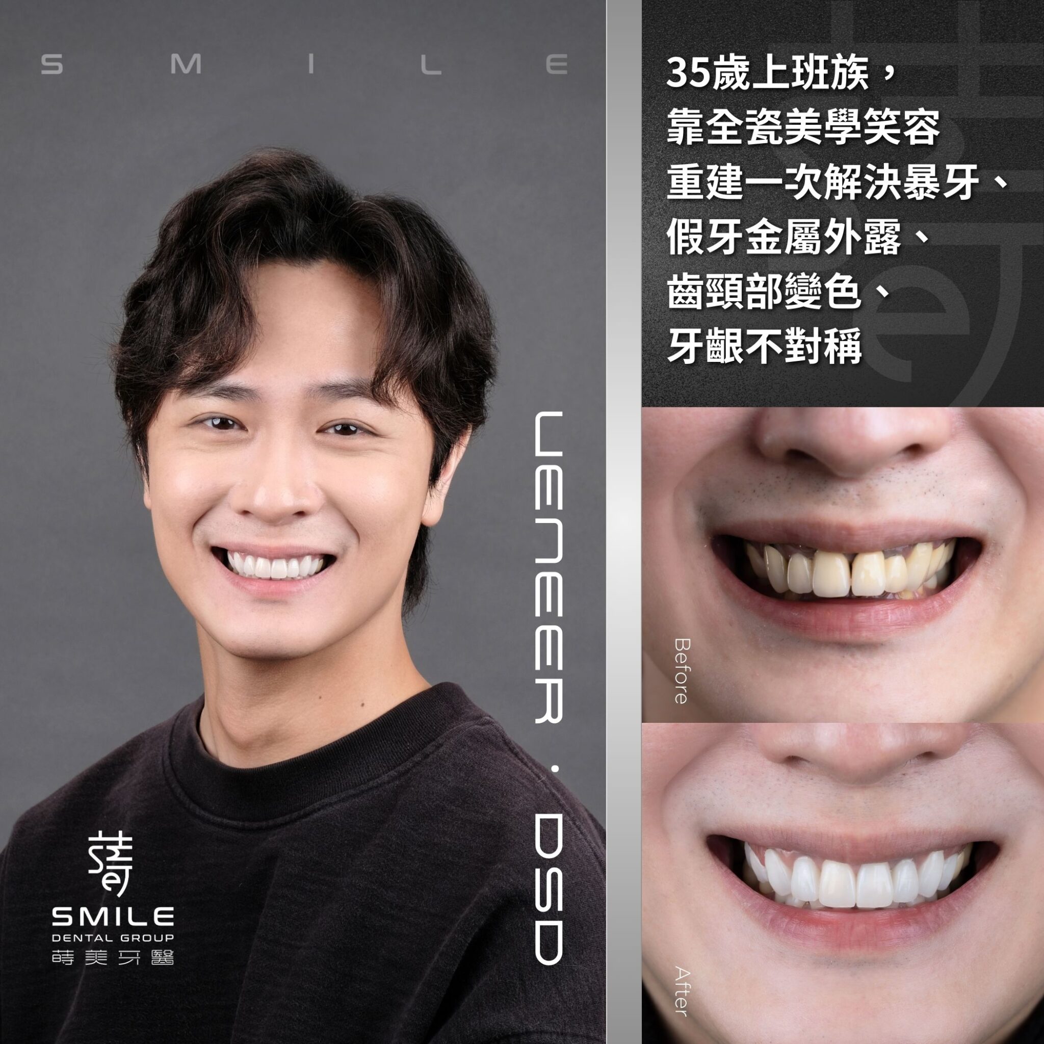 35歲上班族，靠全瓷美學笑容重建一次解決暴牙、假牙金屬外露、齒頸部變色、牙齦不對稱